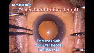 Phaco in a middilated pupil with soft cataract using Constellation Phaco Machine [upl. by Aliam]