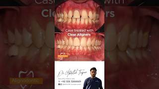 Clear Aligners Invisible Braces Before amp After [upl. by Yennej447]