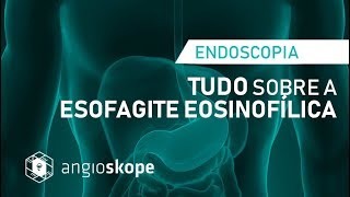 ESOFAGITE EOSINOFÍLICA  Saiba TUDO   Dra Carol Hoff  Clínica Angioskope [upl. by Adian]