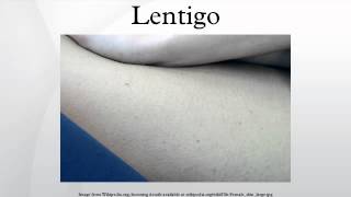 Lentigo [upl. by Lupien]