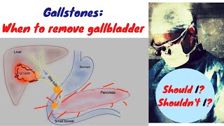 Gallstones when to remove the gallbladder [upl. by Marianne]