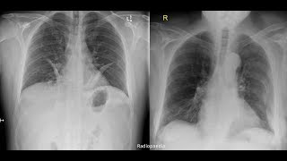 How to Interpret a Chest XRay Lesson 1  An Introduction [upl. by Suolkcin]