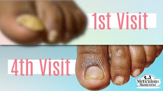 Pedicure Transformation from Detached Toenail ➜ Healthy amp Reattached [upl. by Aiceila497]