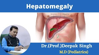 Hepatomegaly Enlargement of liver  Deepak PD Singh [upl. by Dahl]