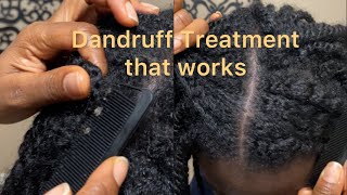 Try This Dandruff Treatment See Change in 1 Week  DiscoveringNatural [upl. by Tal]