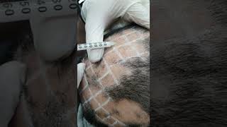 Demo19 Intralesional triamcinolone for alopecia areata [upl. by Myrta]