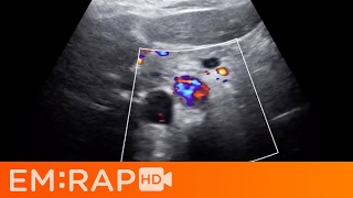 Ultrasound of Aortic Dissection [upl. by Alpheus422]