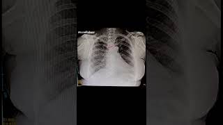 Cardiomegaly Cardiomegaly Heart X ray chest shortvideo [upl. by Eicnan]