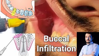 Local Anesthesia Buccal Infiltration Technique Maxillary Anesthesia Techniques dentistry [upl. by Heshum785]