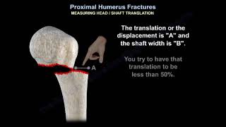 Proximal Humerus Fracture  Everything You Need To Know  Dr Nabil Ebraheim [upl. by Battiste]