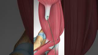 Distal Biceps Tendon Rupture and Repair bicepstendon elbowpain biceps [upl. by Gabey682]