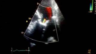 Aortic regurgitation combined with stenosis Ultrasound echocardiography [upl. by Grieve726]