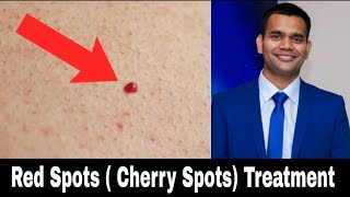 Red Skin Dots  cherry Angioma  Natural Treatment  Dr Vivek Joshi [upl. by Ymmit281]