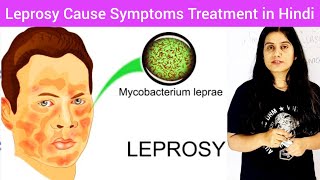 Leprosy Cause Symptoms Treatment Prevention in Hindi  Leprosy In Hindi  LeprosyHansens disease [upl. by Nyrrad]