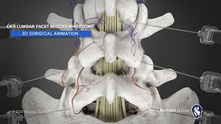 3D Animation of Lumbar Facet Rhizotomy Details Injection Procedure For Pain Relief [upl. by Arnaldo976]