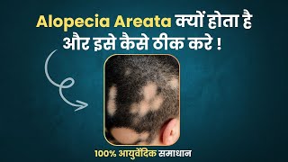 Alopecia Areata Kyu Hota Hai Part  2  Alopecia Areata Natural Treatment [upl. by Sara-Ann838]