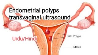 Pelvic Ultrasound transvaginal ultrasoundendometrial polypUterine polyp [upl. by Golda884]