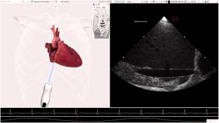 HeartWorks Hypovolemia [upl. by Piper]