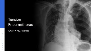 Difference between Pneumothorax and Hemothorax [upl. by Acemahs]