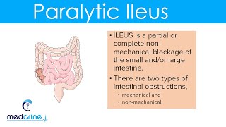 Paralytic Ileus  causes pathophysiology clinical features diagnosis and treatment [upl. by Leimad202]