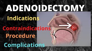 065Adenoidectomy adenotonsillectomy surgeryeducation [upl. by Jodee]