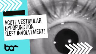 Acute Vestibular Hypofunction Spontaneous Nystagmus Left [upl. by Friedrich]