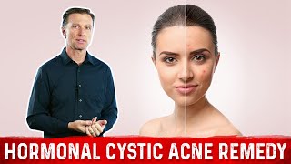 Best Remedy for Hormonal Cystic Acne – DrBerg [upl. by Yrallam]