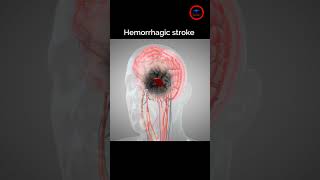 The goal of Treat Hemorrhagic stroke  stroke bleeding [upl. by Hairahcaz]