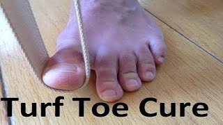 Turf Toe Treatment 1 Min Home Remedy [upl. by Nylteak]