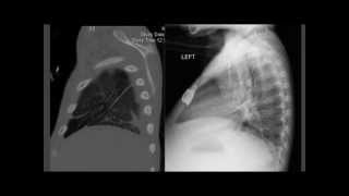 1 cm Pneumonia on PoCUS CXR negative CT positive [upl. by Layol]