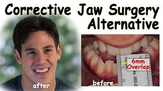 Corrective Jaw Surgery Alternative  Underbite Correction without Surgery [upl. by Rimisac]