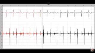 Systolic murmur in mitral regurgitation [upl. by Ephrayim]