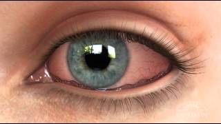 Conjunctivochalasis CCH Dry Eye Animation [upl. by Paulson]