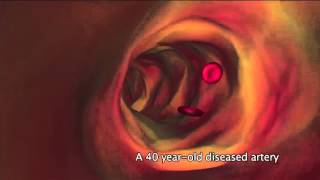 What is atherosclerosis [upl. by Alvira]