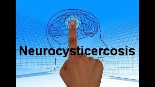 Neurocysticercosis NCC Types Clinical manifestations Diagnosis and Management [upl. by Gentille616]