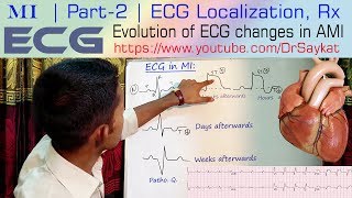 MI  Part 2  ECG Localization amp Treatment of Myocardial Infarction  Dr Saykat [upl. by Aila]