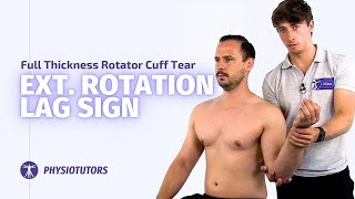 External Rotation Lag Sign  Full Thickness Rotator Cuff Tears [upl. by Kcitrap]