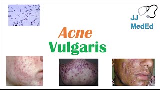 Acne Vulgaris  Causes Pathogenesis Influencing Factors Diagnosis Treatment and Complications [upl. by Aivart]