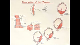 Placental Abnormalities  accreta previa abruption multi lobar [upl. by Alet673]