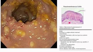 pseudomembranous colitis [upl. by Onivag55]