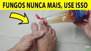 O FIM DA MICOSE E FUNGOS NAS UNHAS Basta 5 Gotas Disso Para Eliminar em 3 Dias [upl. by Yanehc190]