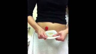 Ostomy pouch change using ConvaTec moldable [upl. by Bal]