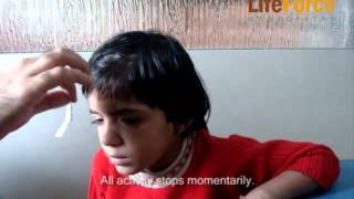 Video of Child with Petit Mal Epilepsy Attack Induced by Exertion Physical Effort [upl. by Dalis]