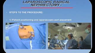 LAPAROSCOPIC RADICAL NEPHRECTOMY PROCEDURE OVERVIEW [upl. by Ludlew37]