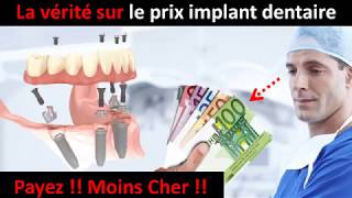 Prix implant dentaire  partie 1 [upl. by Yrekaz]