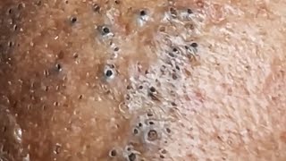 Blackheads amp Whiteheads Satisfying Removal 0050 [upl. by Airetal]