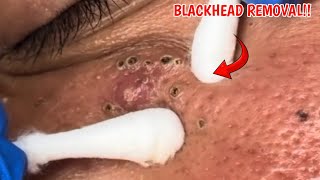 Blackhead removalAcne treatment from DR NOPRIZAL 6 [upl. by Niel]