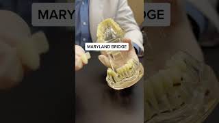 How fixed by the JXEJXO 🦷🦷 Protective braces in Maryland Bridge savemoney healthmisstooth [upl. by Werdn]