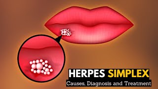 Herpes Simplex Causes Signs and Symptoms Diagnosis and Treatment [upl. by Jacoby368]