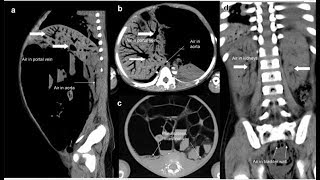 Pneumatosis intestinalis und tödliche portosystemische Luftembolie [upl. by Ethbinium]